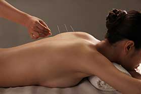 acupuncture for lower back pain Davie, FL